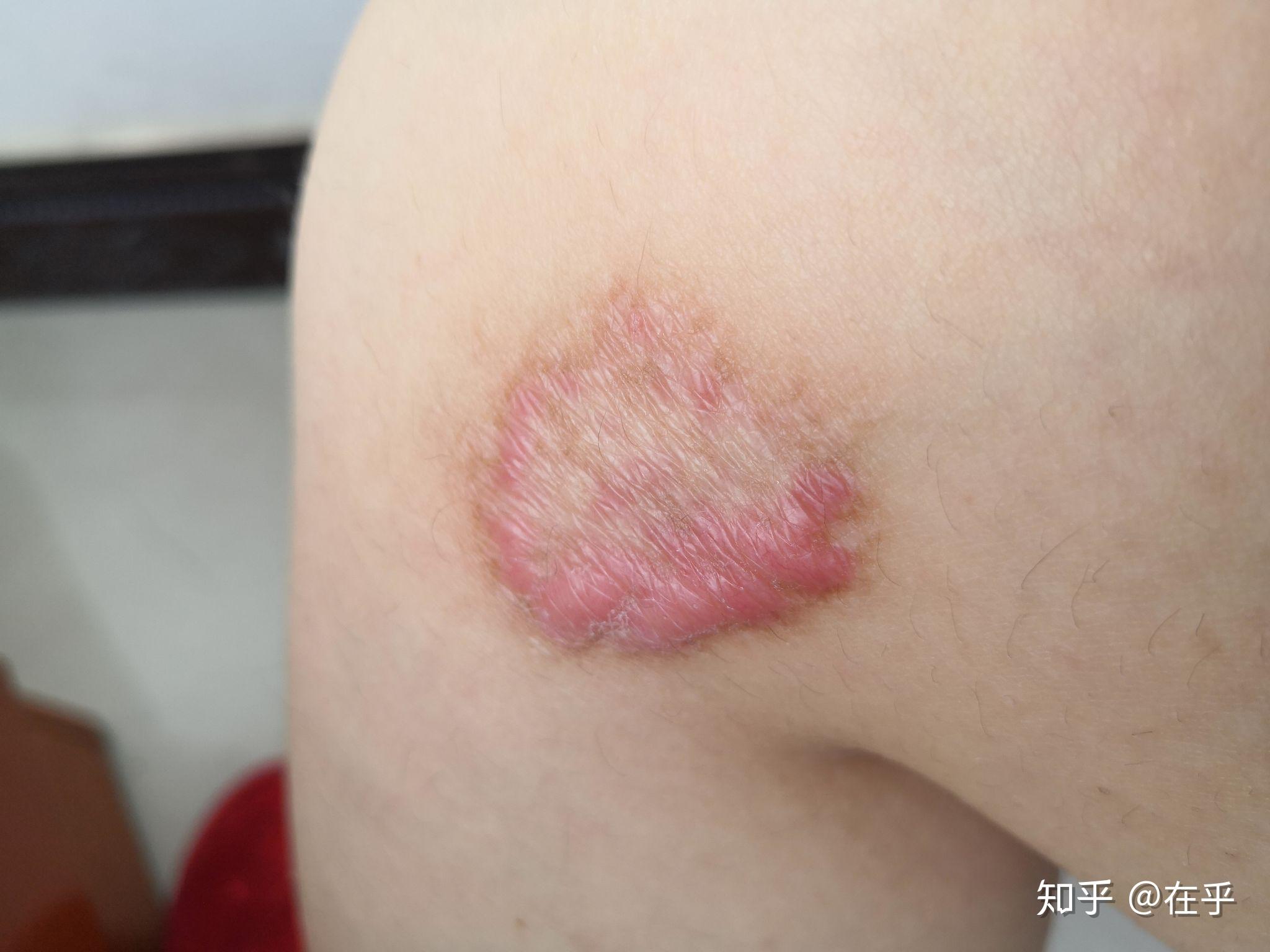 怎样去除腿上摔伤留下的疤痕呢