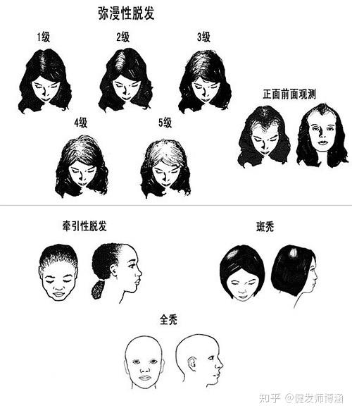 脱发也分男女女性脱发有哪些类型