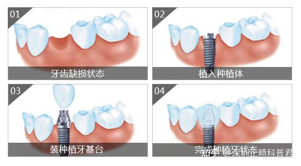 种牙流程看这一篇就够了 苏墙月下 第一次:常规种植到院来说需要到院