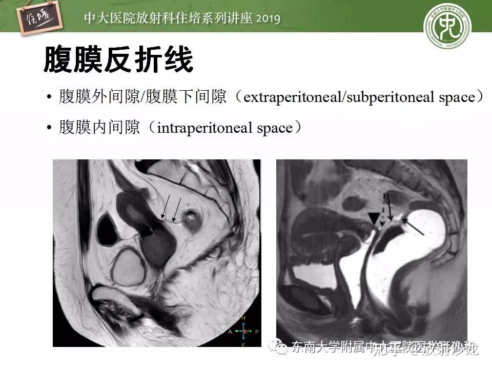 子宫详细解剖及磁共振信号分析 - 知乎