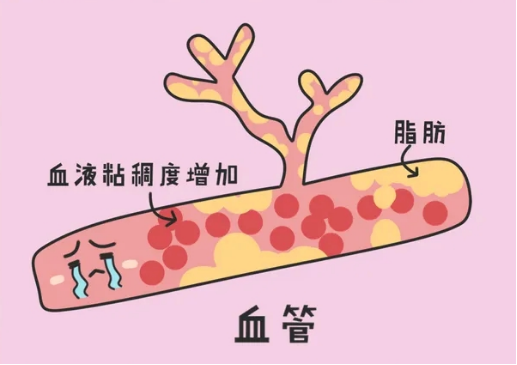 肥胖是血脂异常的表象