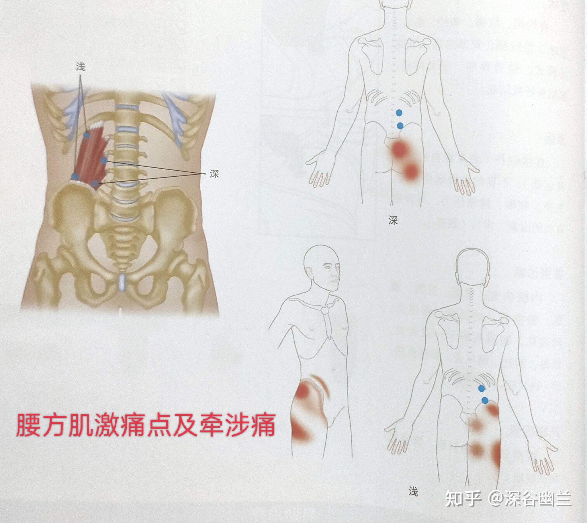 臀部与大腿外侧疼痛相关激痛点及穴位