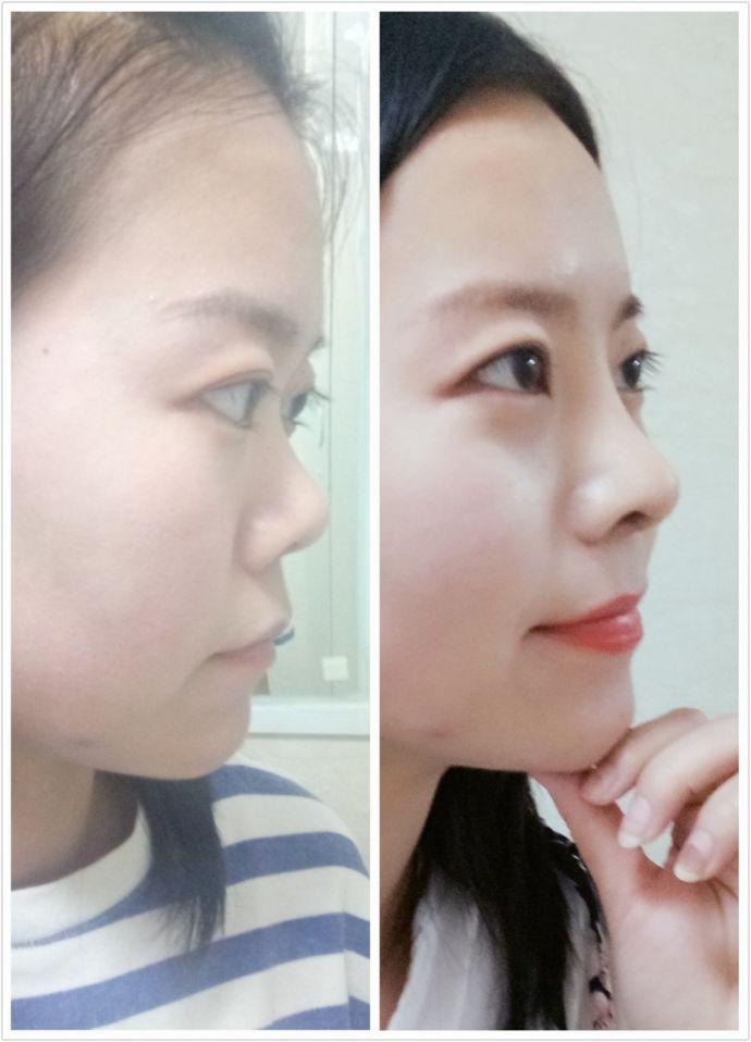 朝天鼻矫正膨体隆鼻手术-有惊无险的抱抱