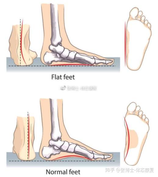 体态矫正 对扁平足的全面阐述 以及最优化的矫正训练方法 知乎
