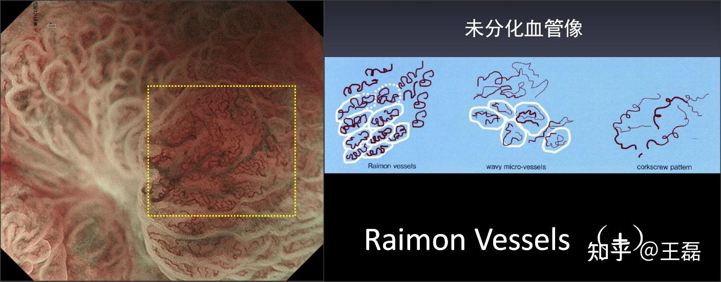 一例发生于慢性萎缩性胃炎的微小印戒细胞癌~ - 知乎