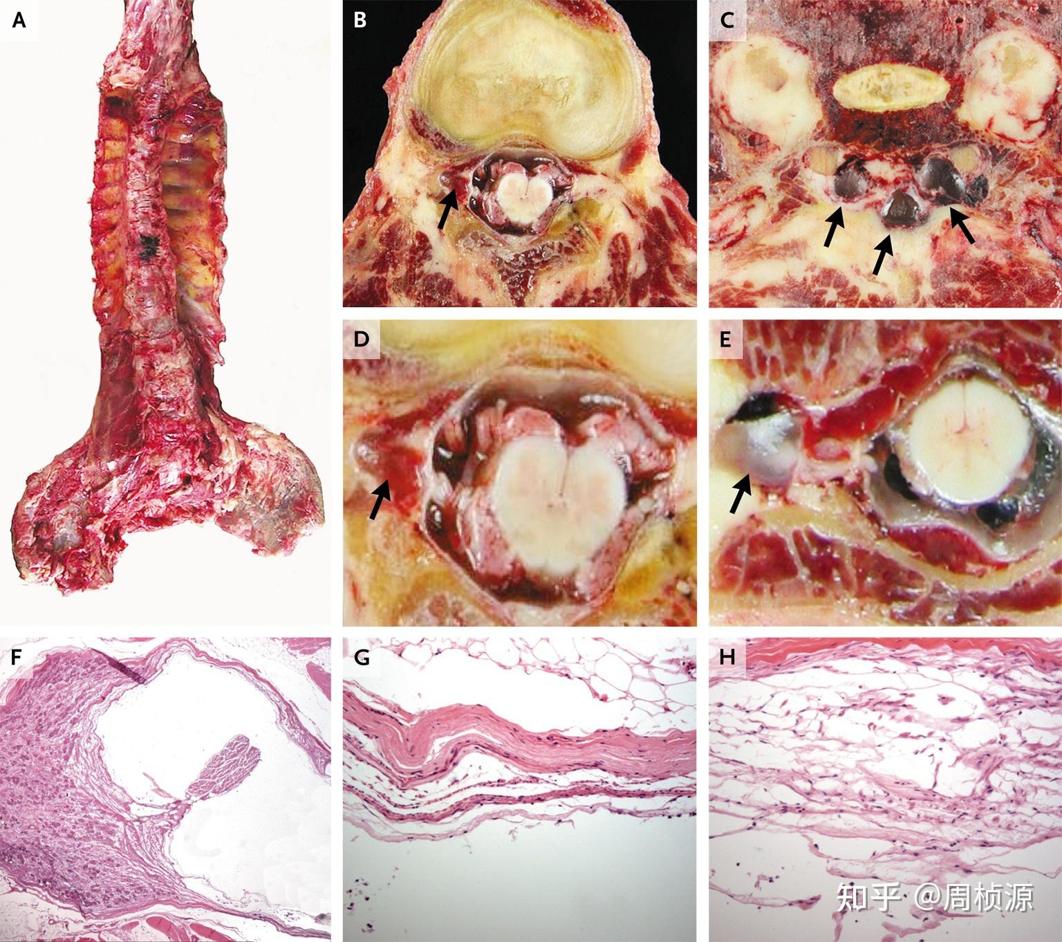 figure 2.characteristics of tarlov cysts.figure 3.