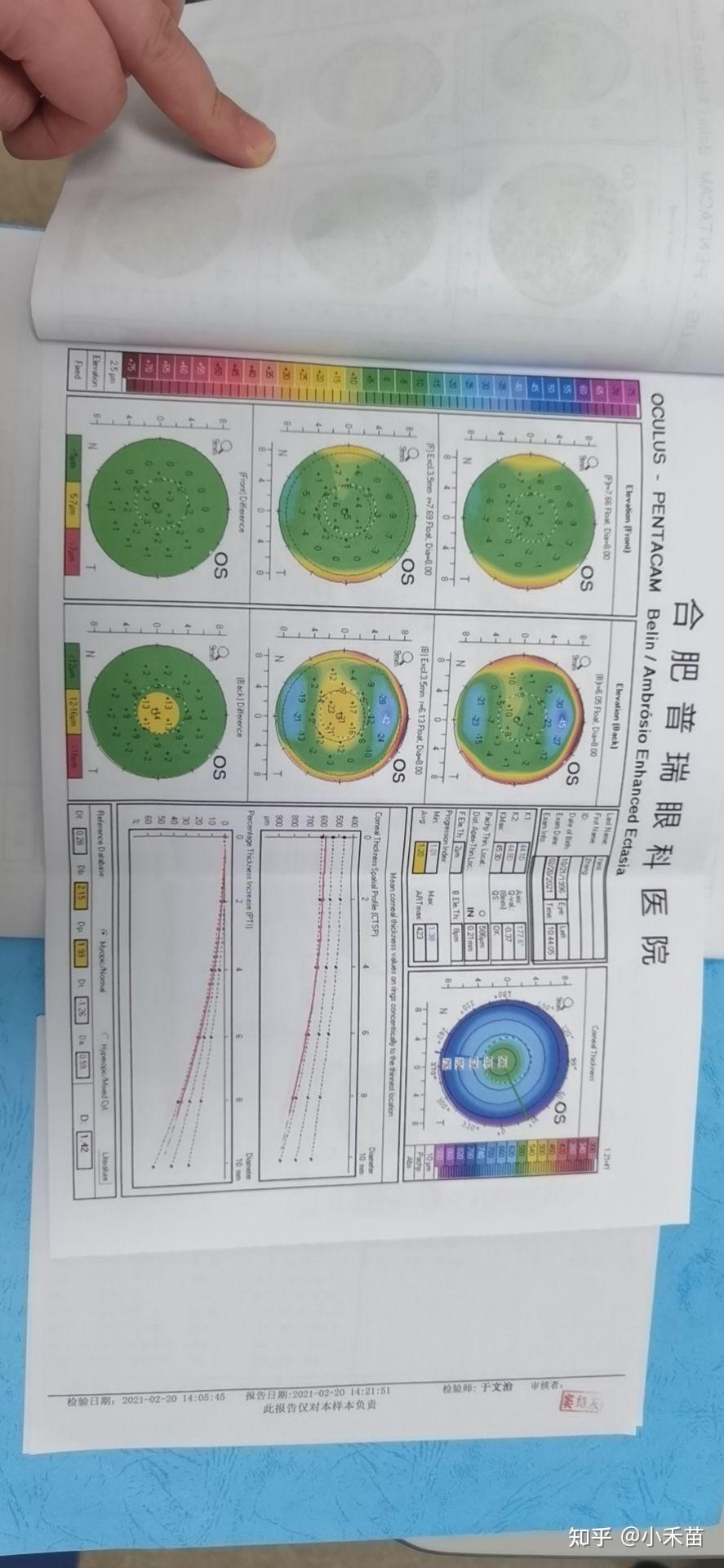 圆锥角膜 - 知乎
