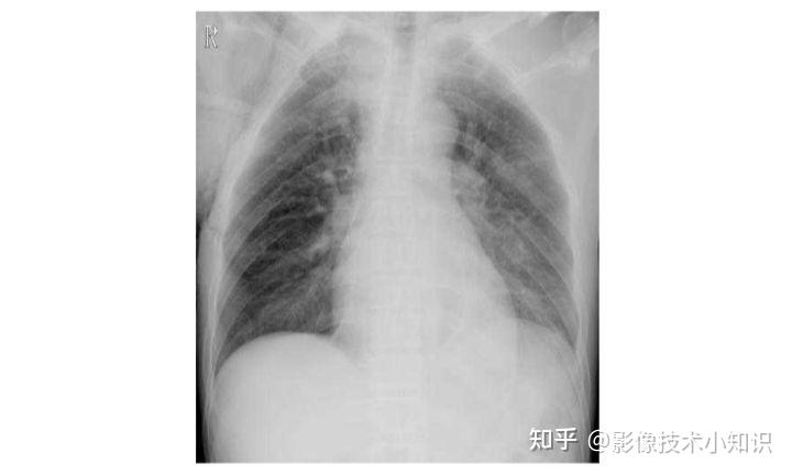 图+影像诊断报告(肺挫伤) 知乎
