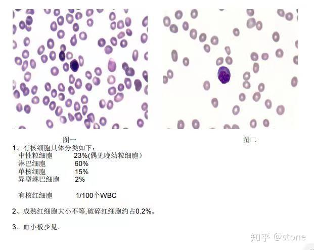 20230807E2021-W28-全血细胞减少-M3 - 知乎