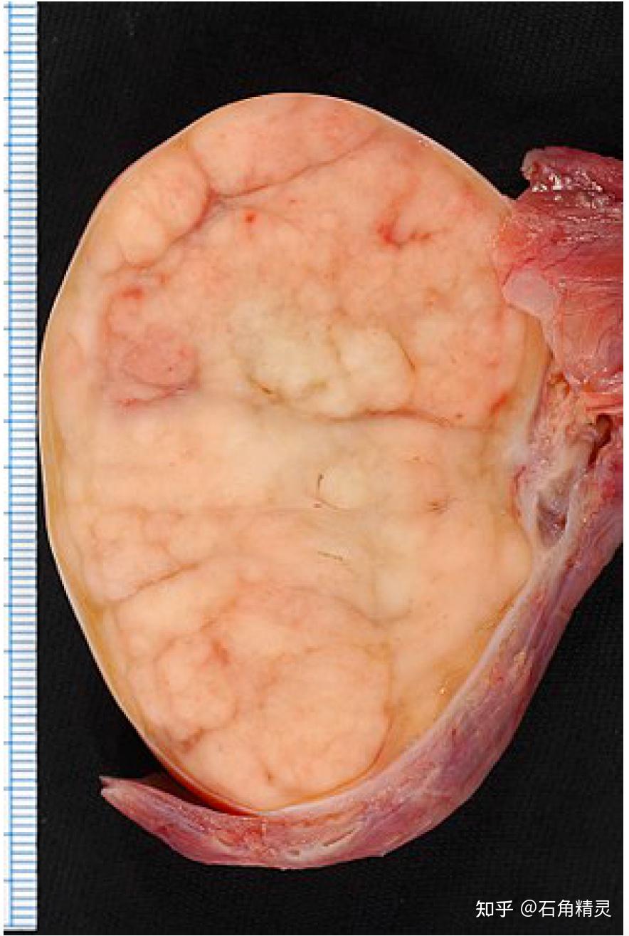 睾丸癌的早期真实图片图片