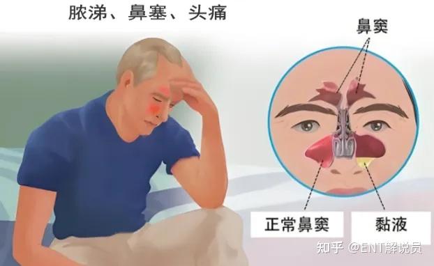 鼻窦炎来袭,后果竟如此严重!重新认识你的鼻窦 - 知乎