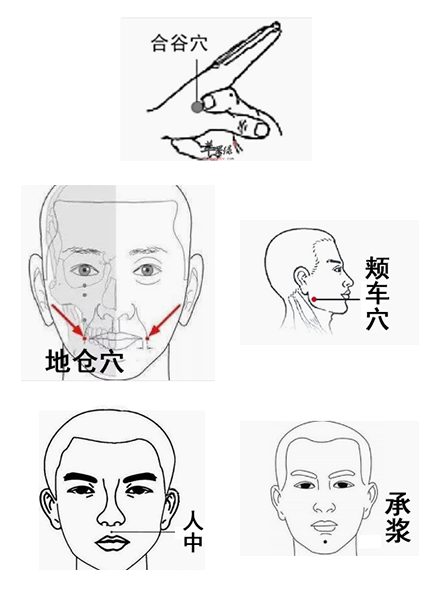 常用的针灸穴位有:双侧合谷穴,地仓透刺颊车穴,人中配合承浆,特殊穴位