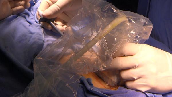 超声下经皮穿刺腹透导管植入附视频