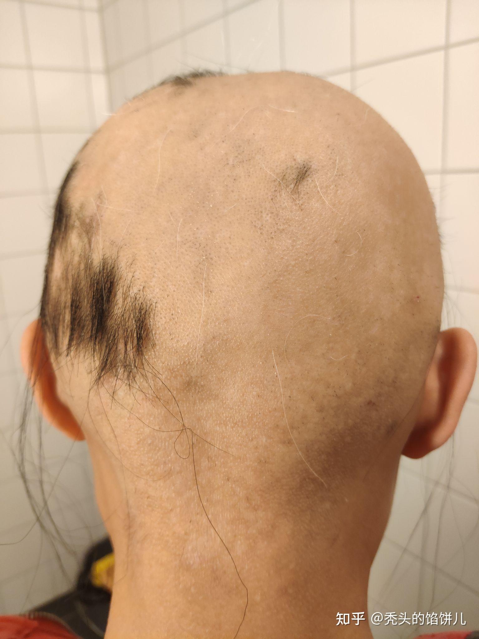 斑秃长头发的过程图片