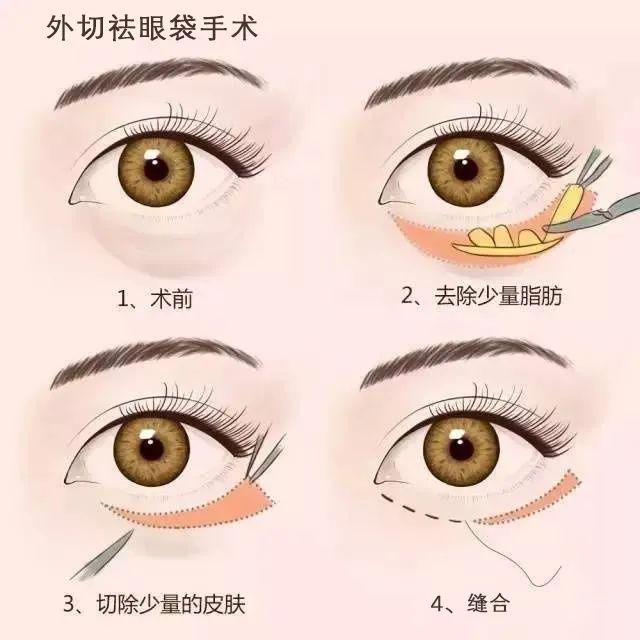 外切祛眼袋手术