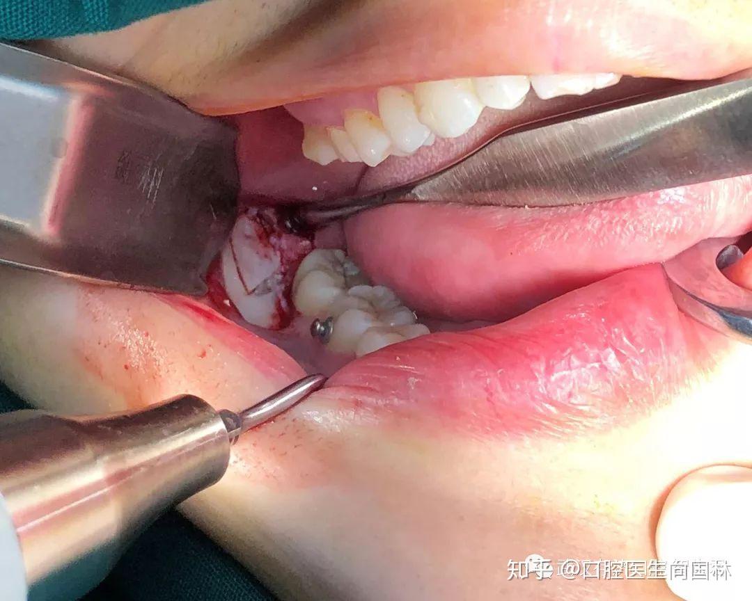 智齿案例全麻舒适化下超声骨刀微创拔除全口埋伏阻生智齿