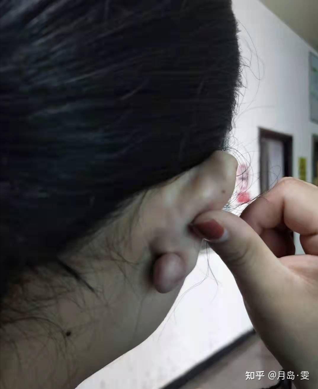 痒,在我的无限抓挠刺激下,它疯狂生长,如图上了大学跟风去打了耳洞