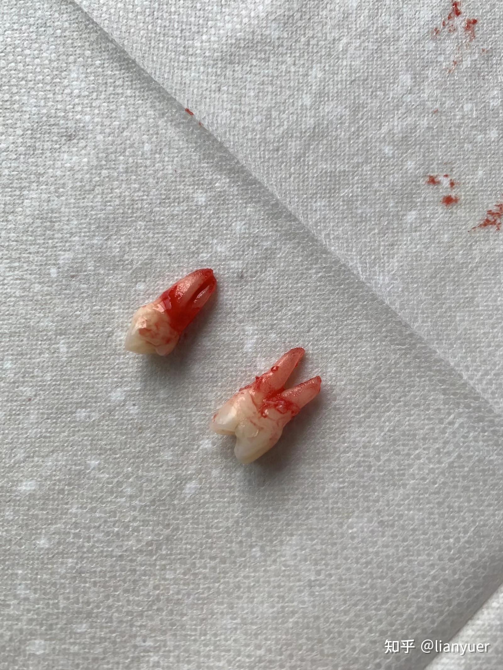 insignia定制牙套30多岁人的正畸