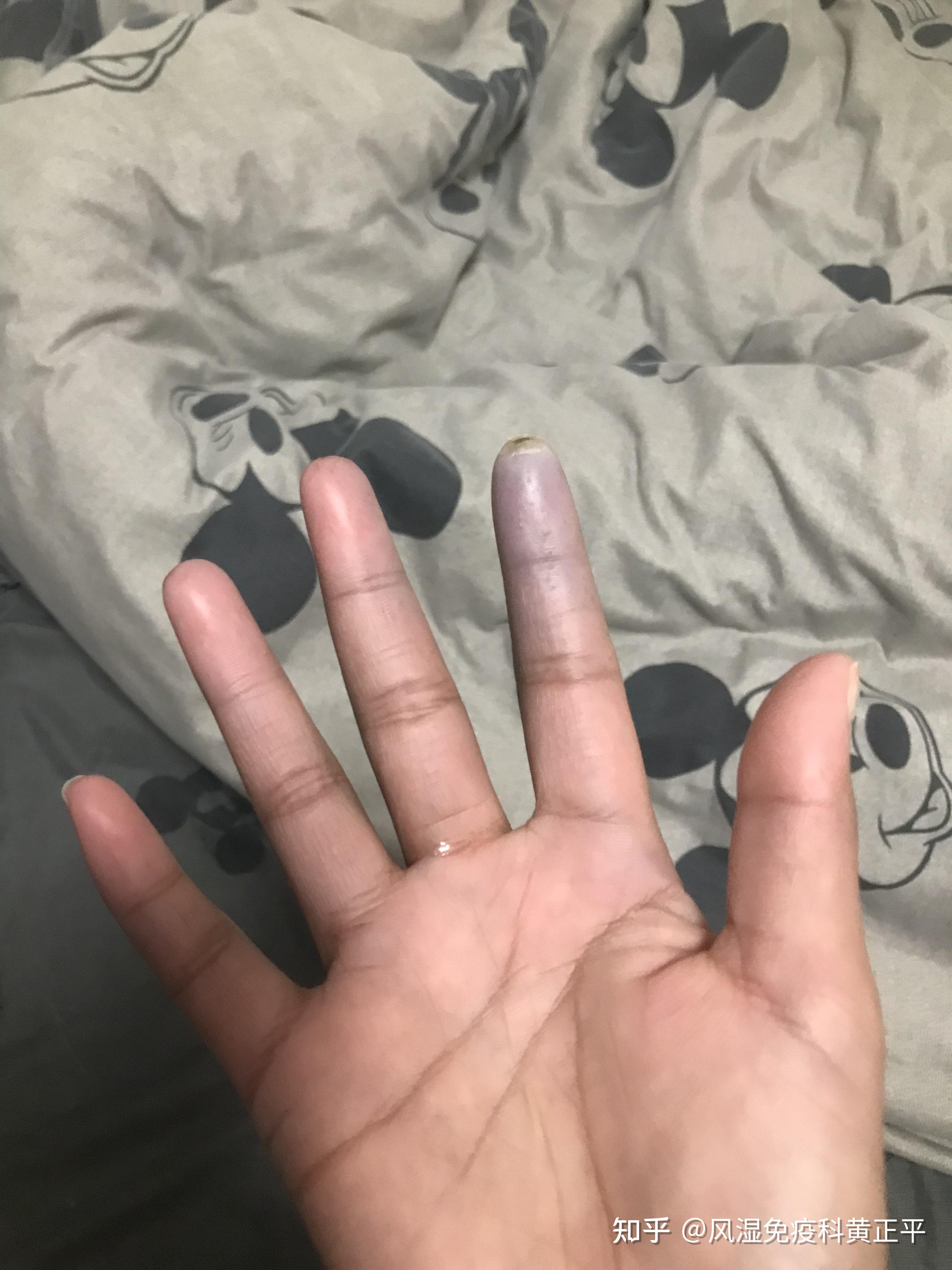 天气变冷手指变白变紫,小心雷诺现象 - 知乎