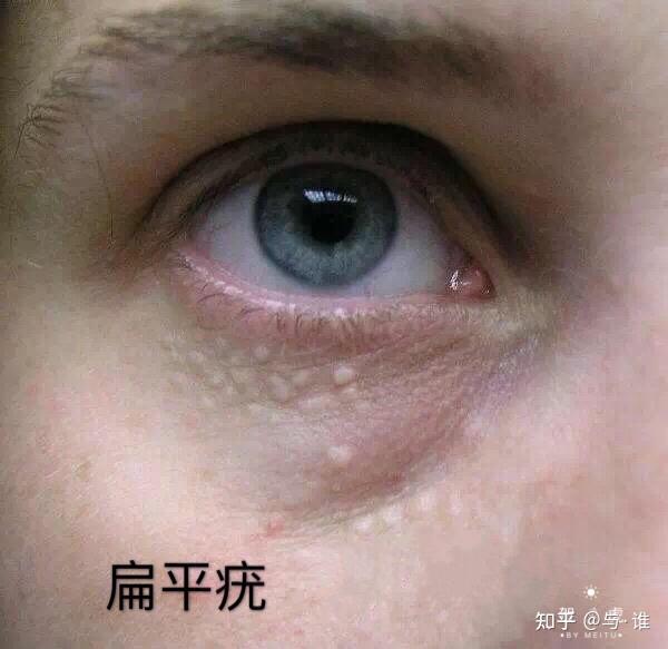 三,什麼是扁平疣扁平疣屬於病理性的問題,由人乳頭狀瘤病毒感染引起的