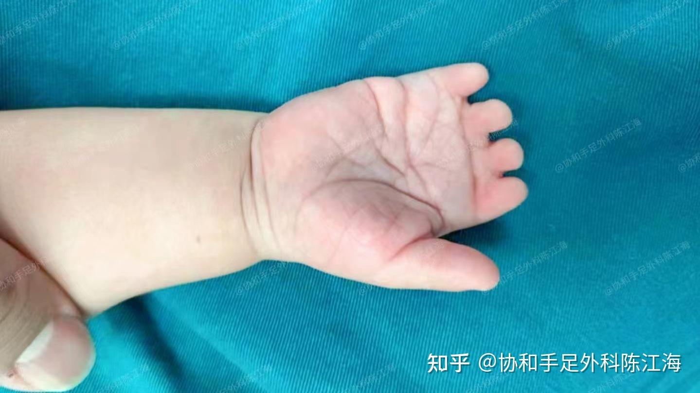 并指畸形有几种类型?医生:一般可分为这4种! - 知乎