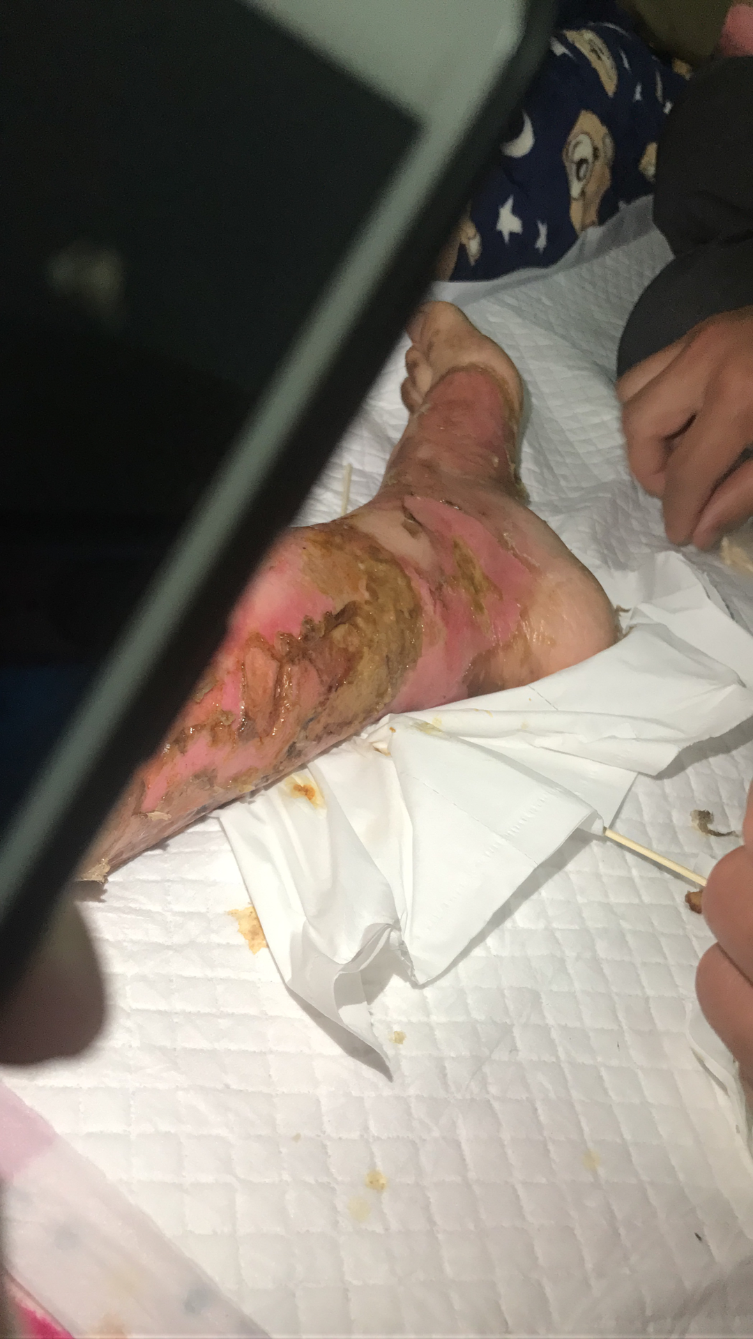 深二度烫伤恢复的心路历程大神帮忙看下会不会留疤