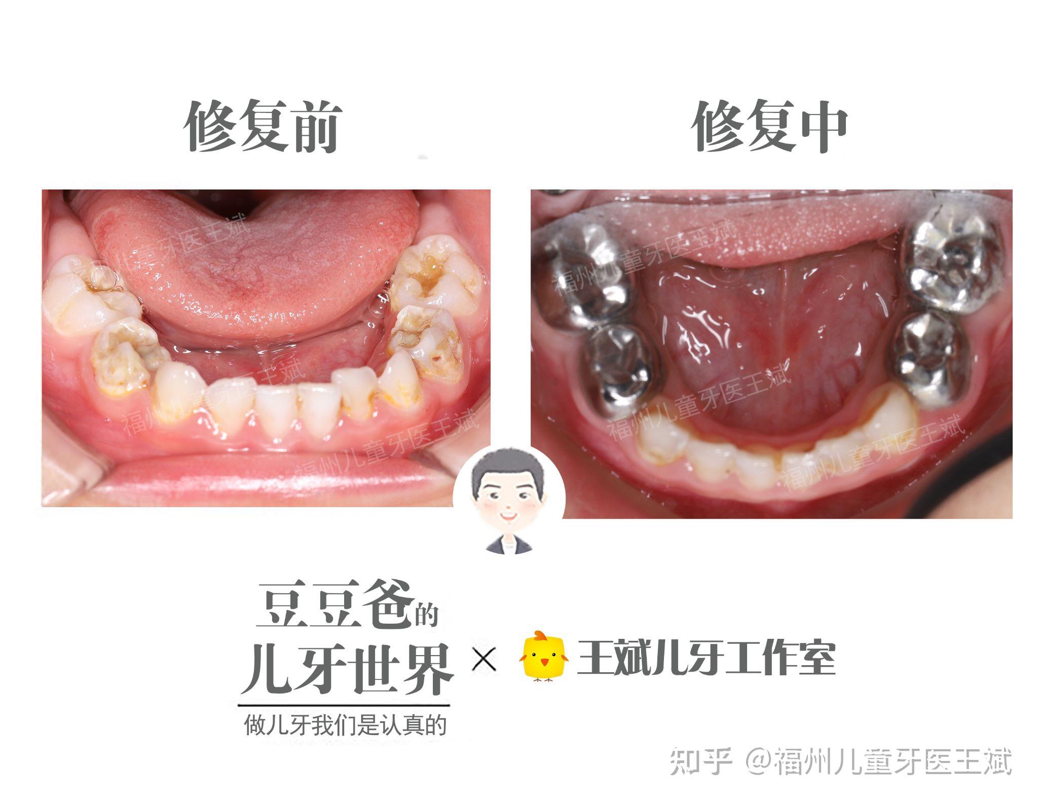 预成冠修复 知乎