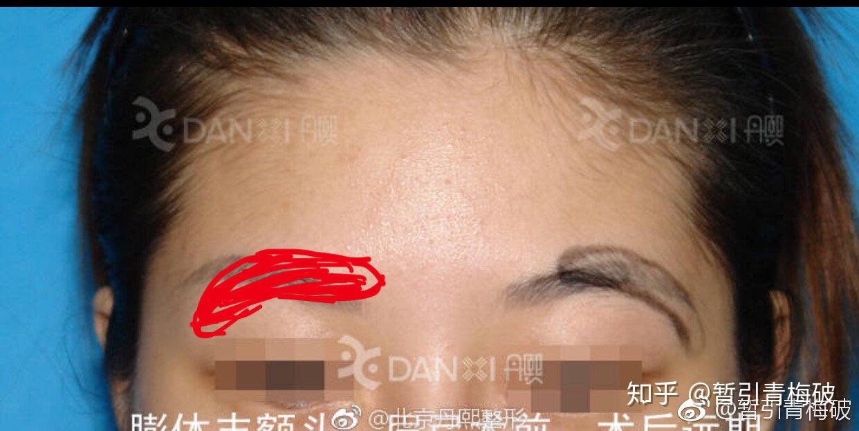 眉弓形态功课 - 知乎