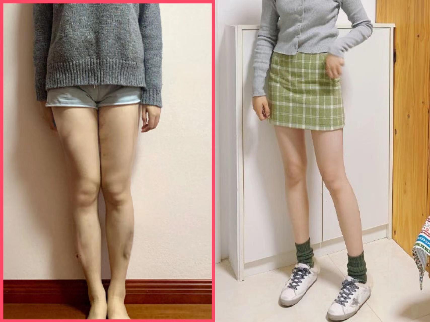 求推荐安全靠谱的吸脂医生(含腰腹,大腿,手臂吸脂) - 知乎