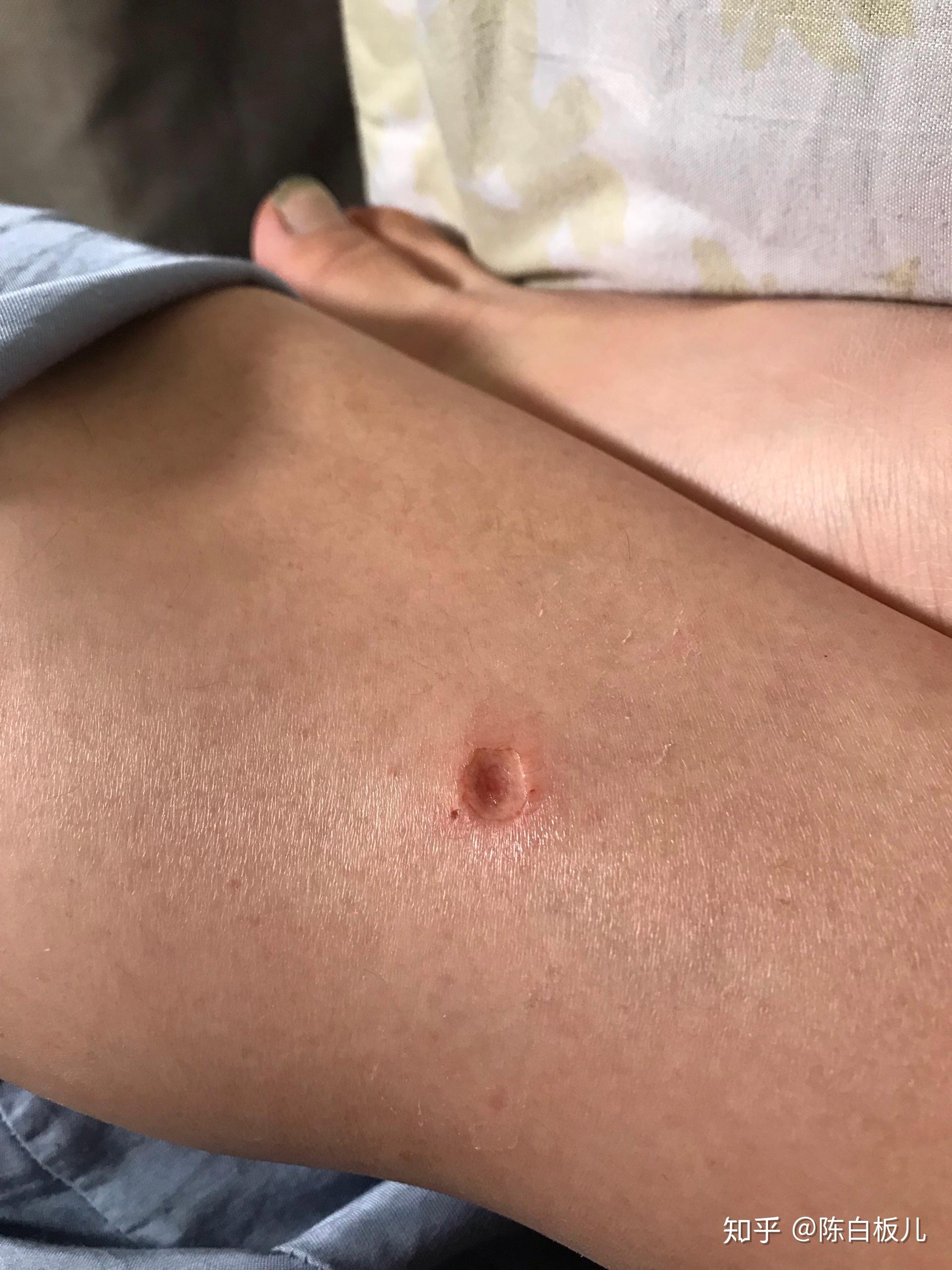 激光祛疣后如何避免留疤