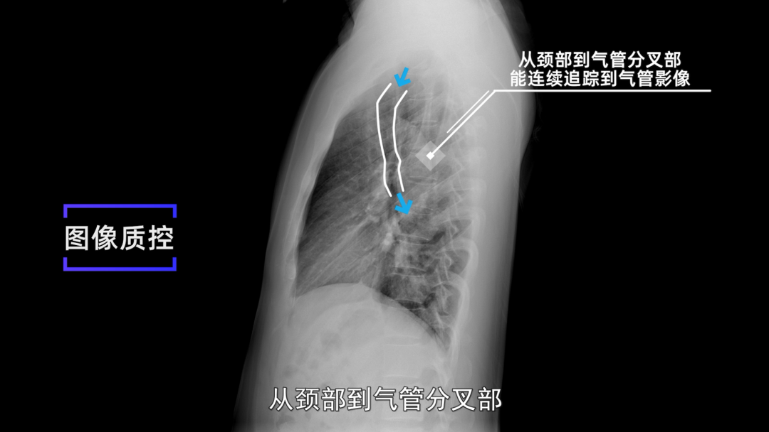 【收藏】|X线摄影技术《胸部正侧位摄影》标准摆位图文解析！ - 知乎