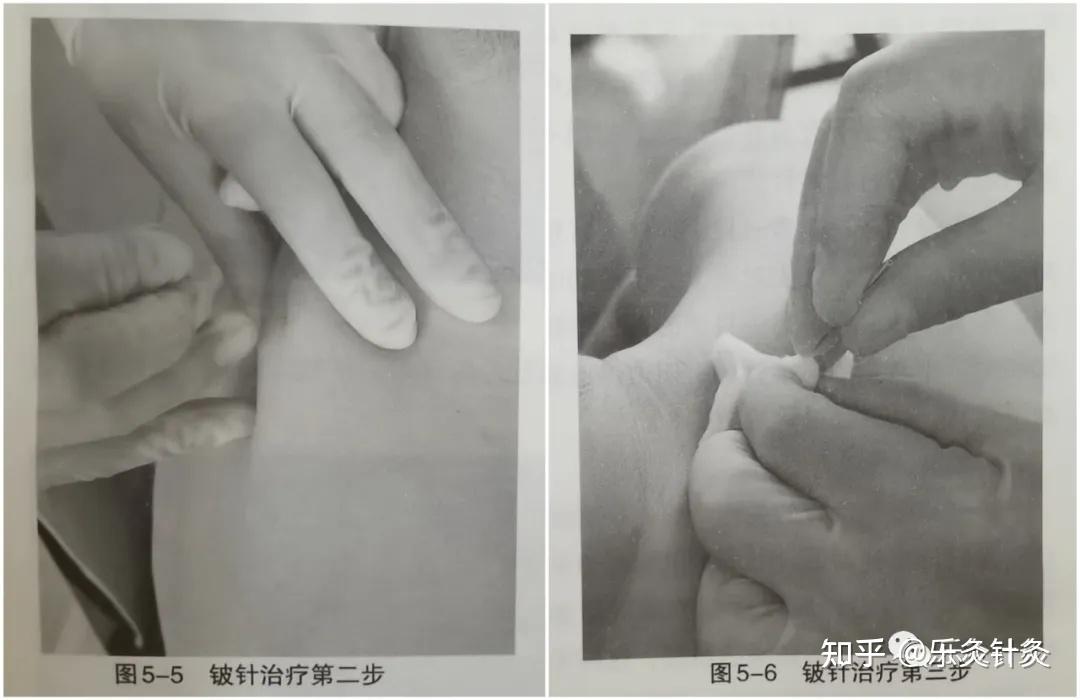 董福慧教授铍针的操作方法