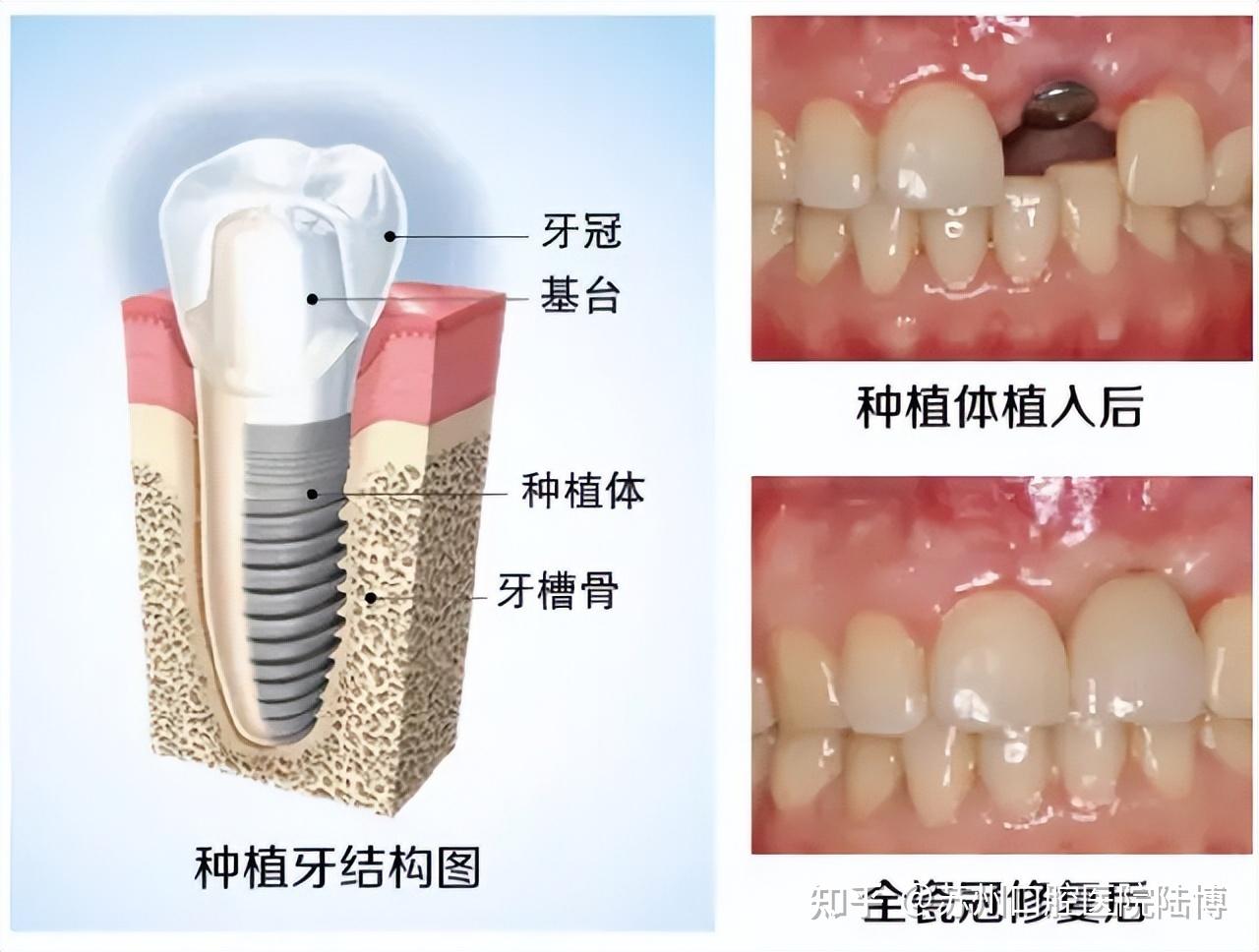 一,什么是种植牙?