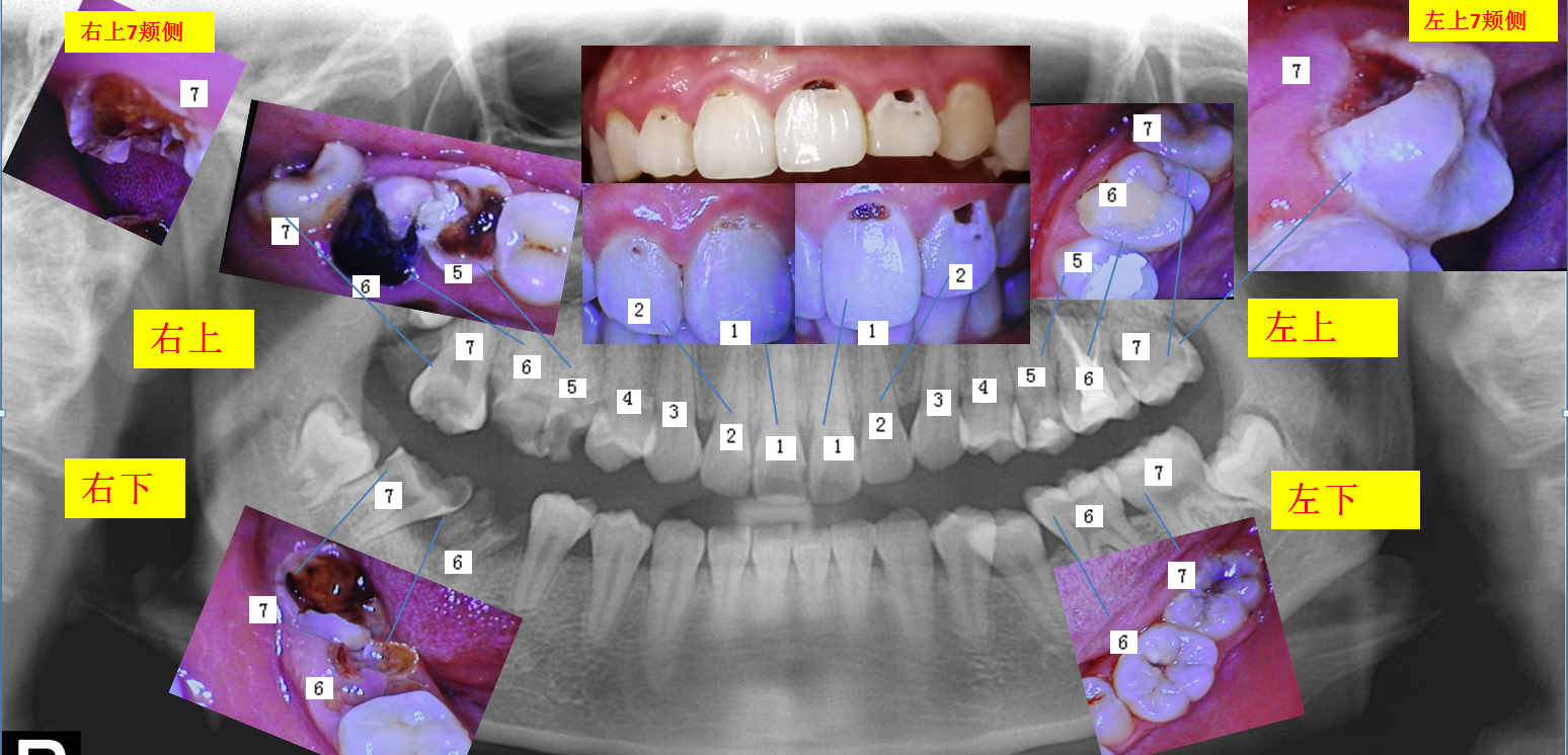 很多十五六歲的小孩,第一第二磨牙(六號牙和七號牙)萌出沒有幾年就齲