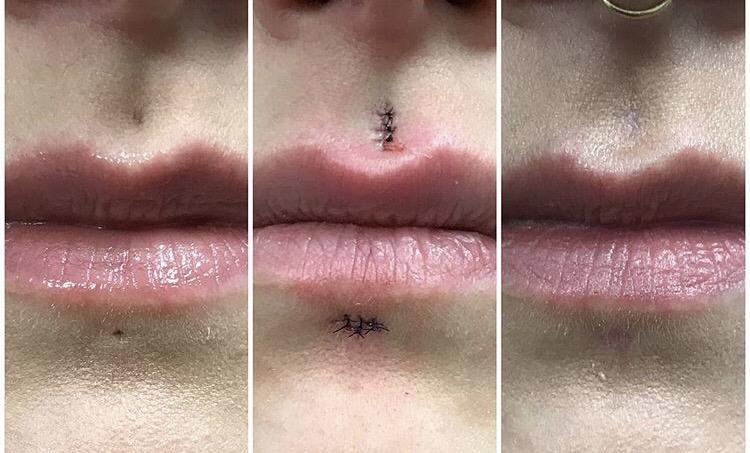 <p>如果是没有任何炎症状况下摘掉的唇钉,大多数人是留下"萎缩