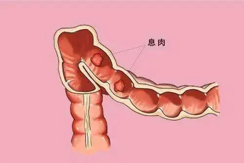 查出腸息肉了會不會癌變出現這4種現象你的息肉可能癌變了