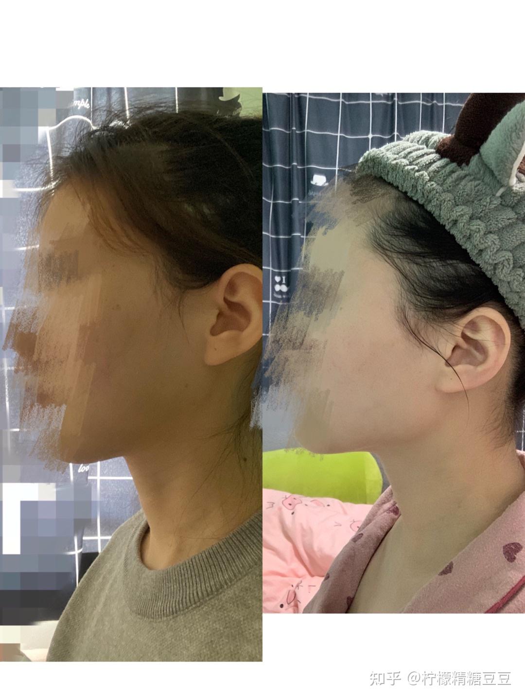 磨骨术_磨骨术_磨骨术