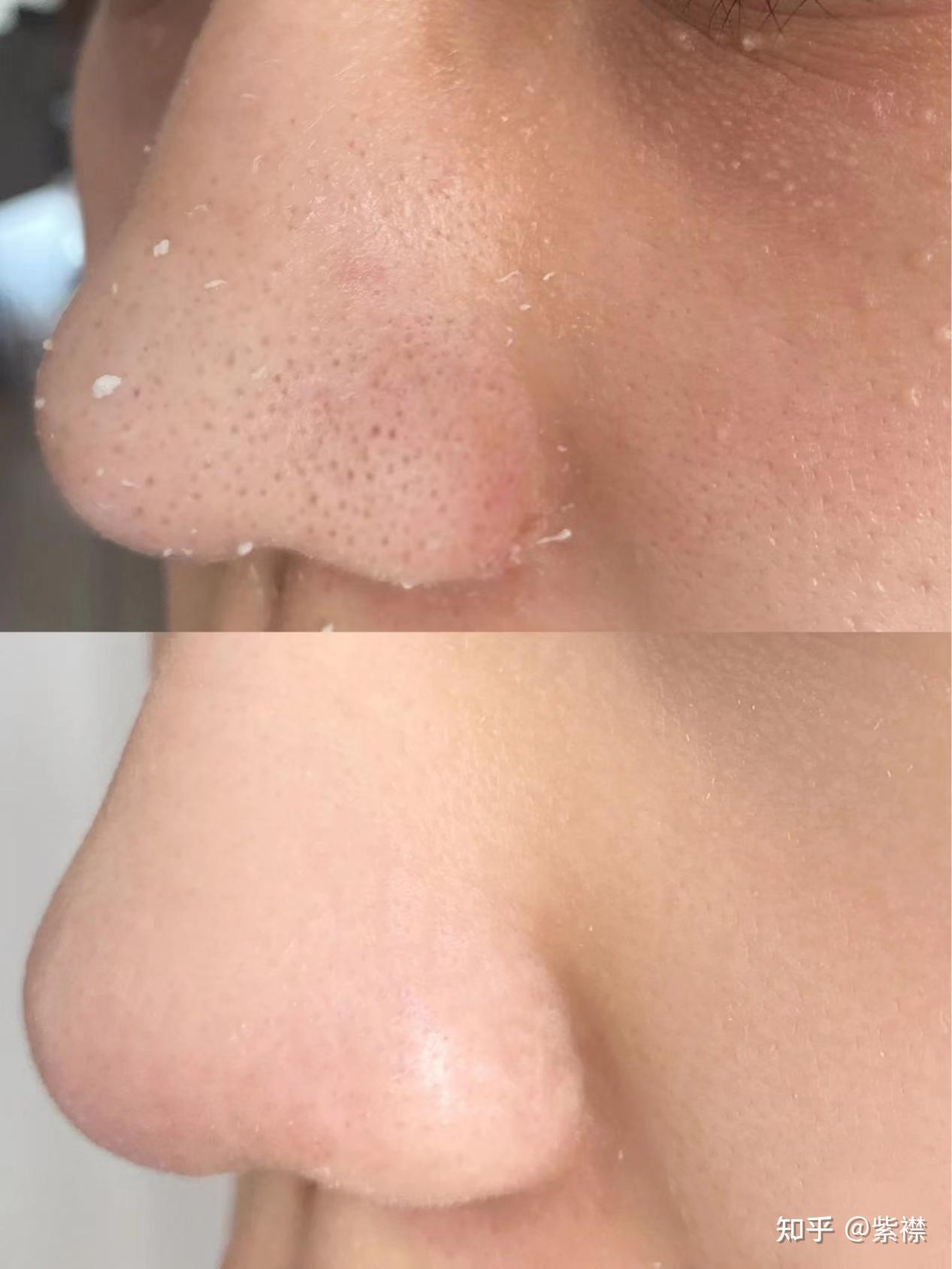 什么方法去黑头比较快