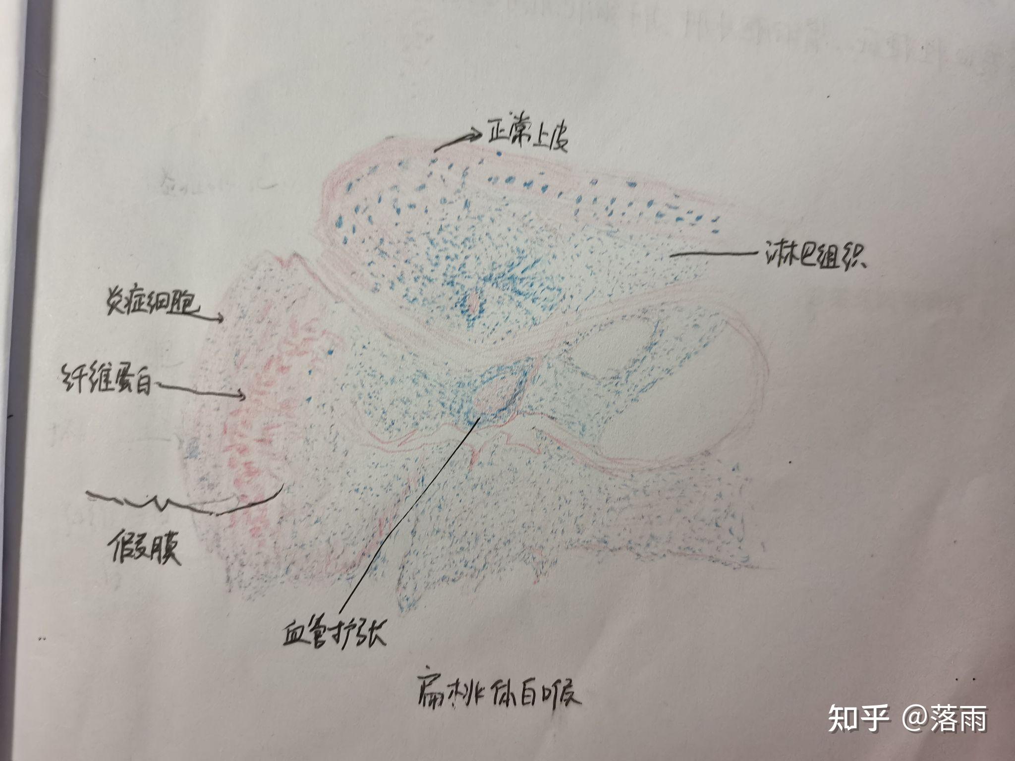 葡萄胎绘图图片