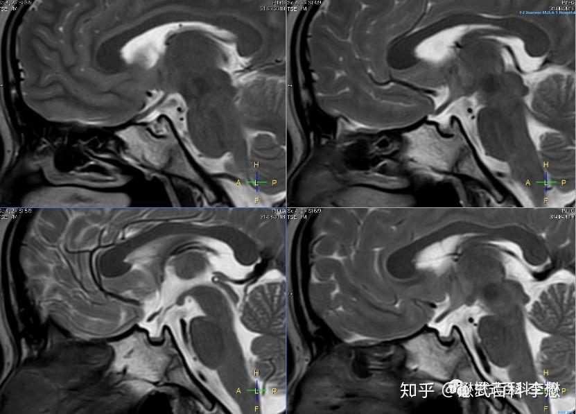 磁共振垂体扫描pituitary mr imaging(一) 