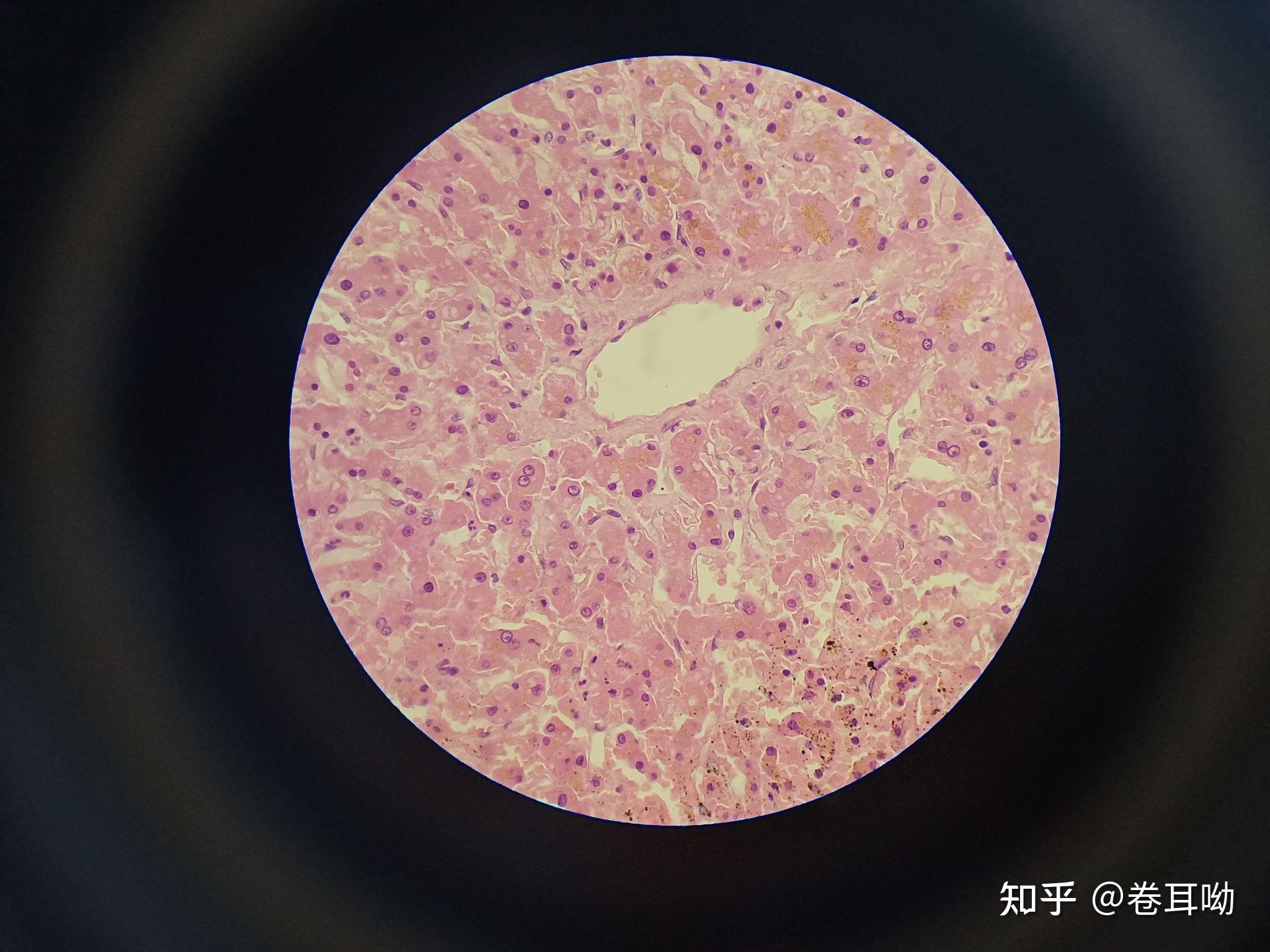肝淀粉样变40x间质性肺炎10x间质性肺炎40x小动脉粥样硬化10x小动脉