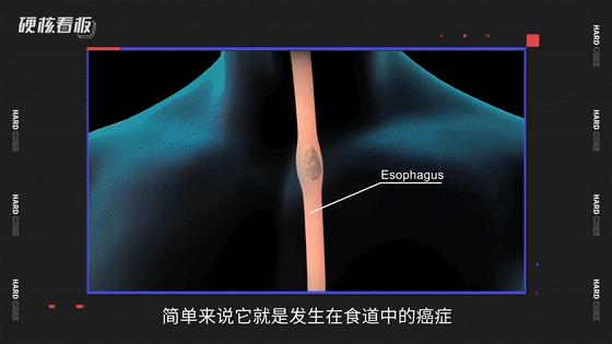 演員塗們因食道癌去世為何食道癌一發現就是晚期如何預防