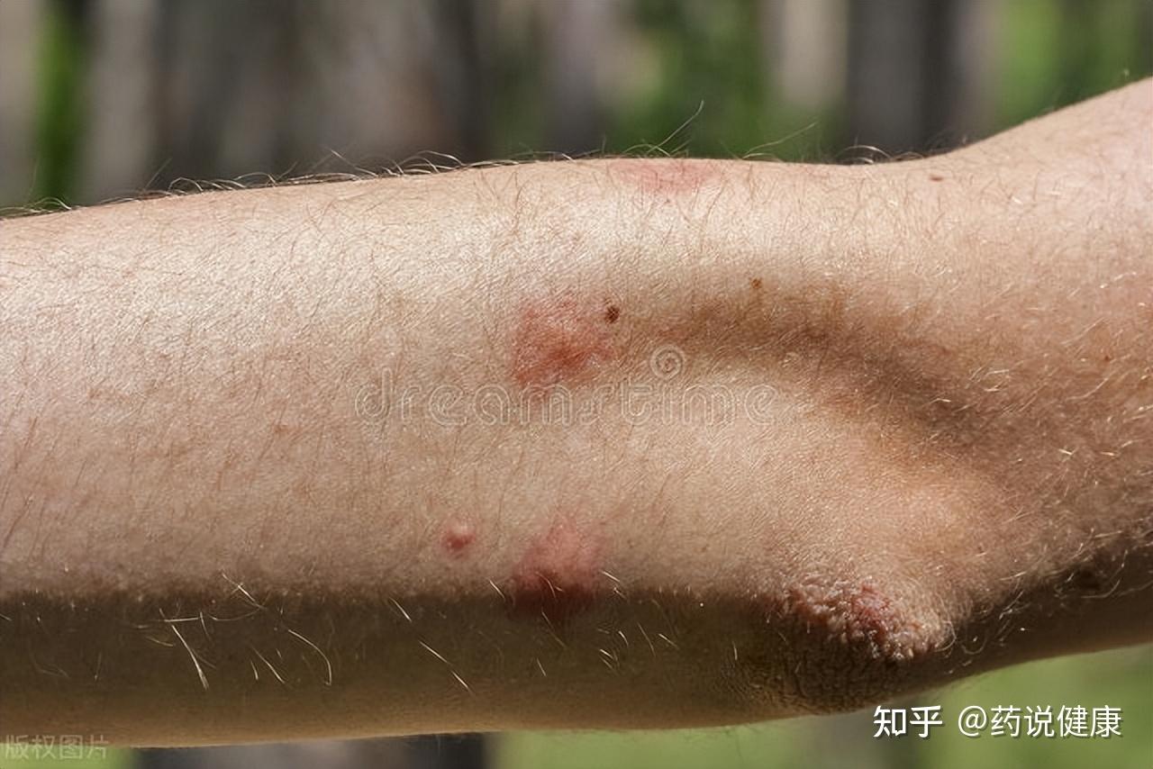 躲过了新冠,避开了甲流,又来一个登革热!