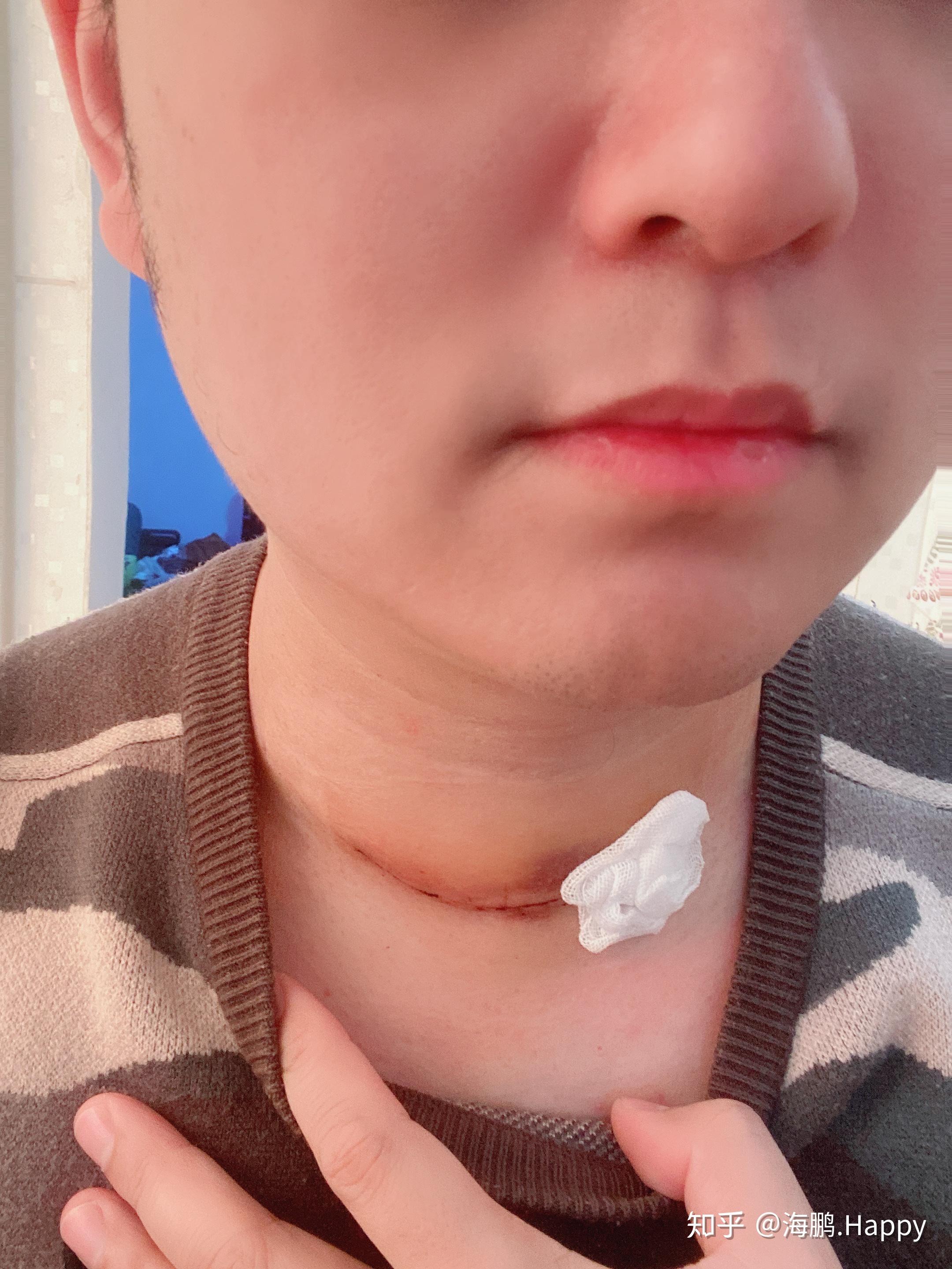 一个甲状腺癌患者在北京的求医之路