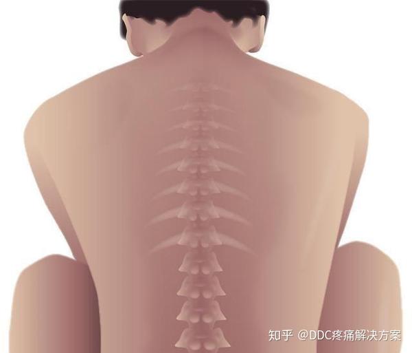 夏季颈椎病高发期 10个颈椎8个痛 知乎