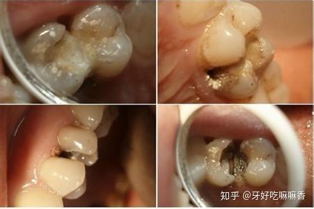 全牙釉质发育不全,"盔甲已经坏掉了",自然就没有办法保护牙本质和牙髓