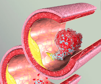 凝血功能障碍是一种什么样的疾病