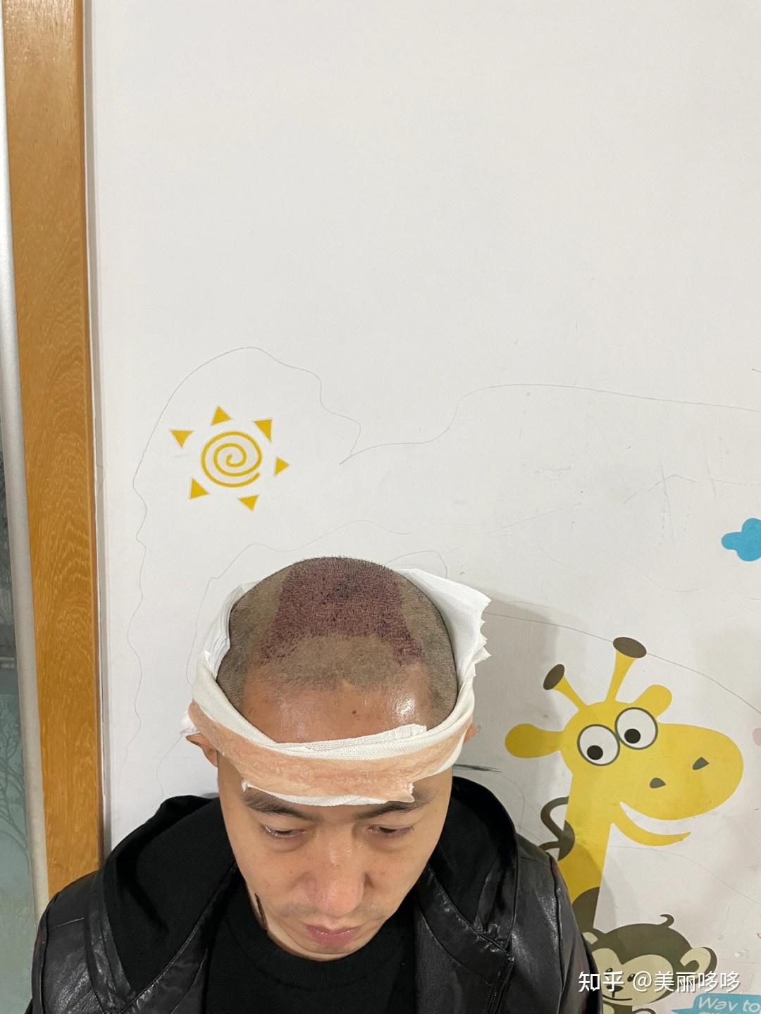 植发当天体检(植发需要做什么体检)