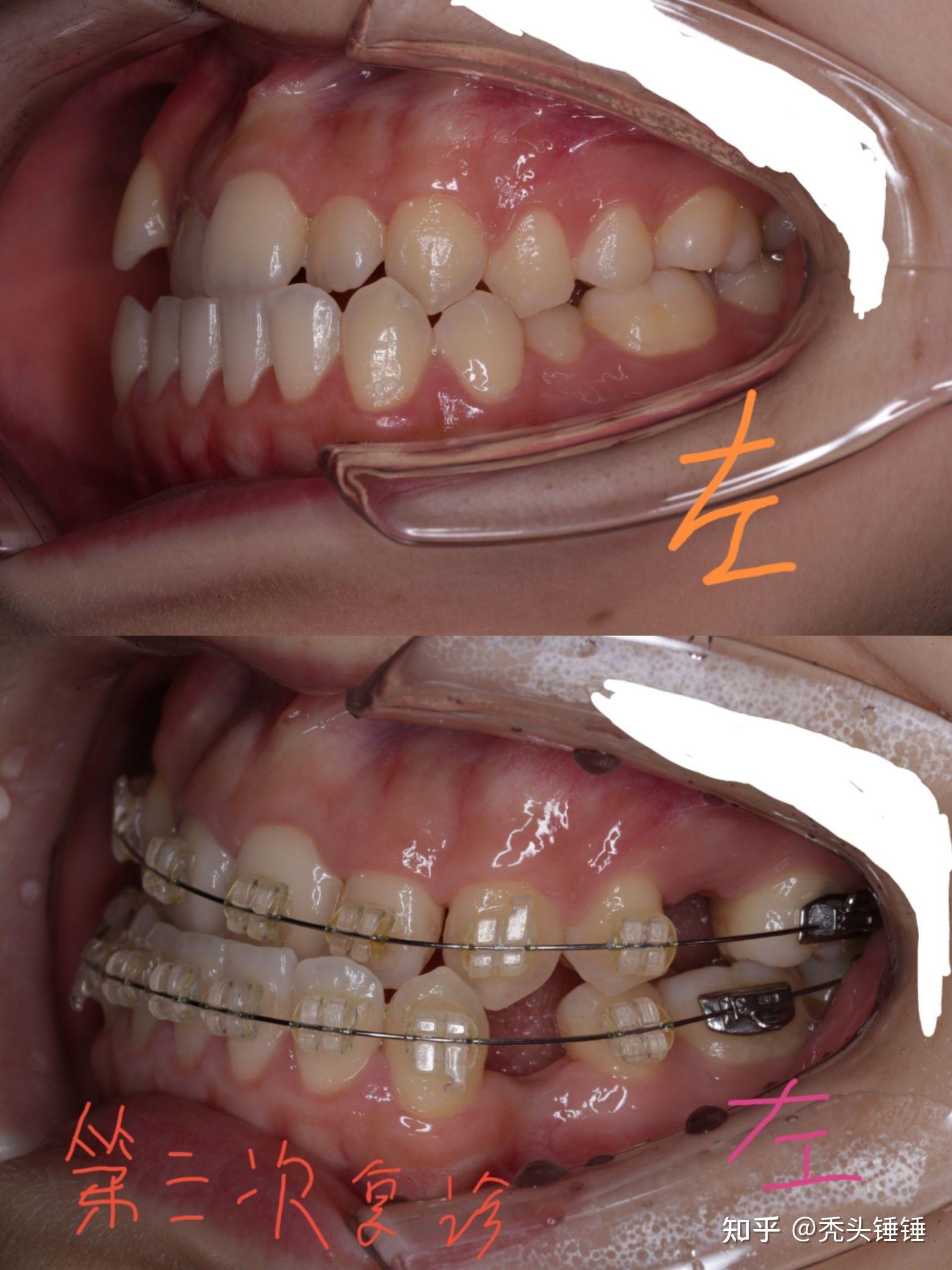 牙齿骨性反颌矫正 记录给自己