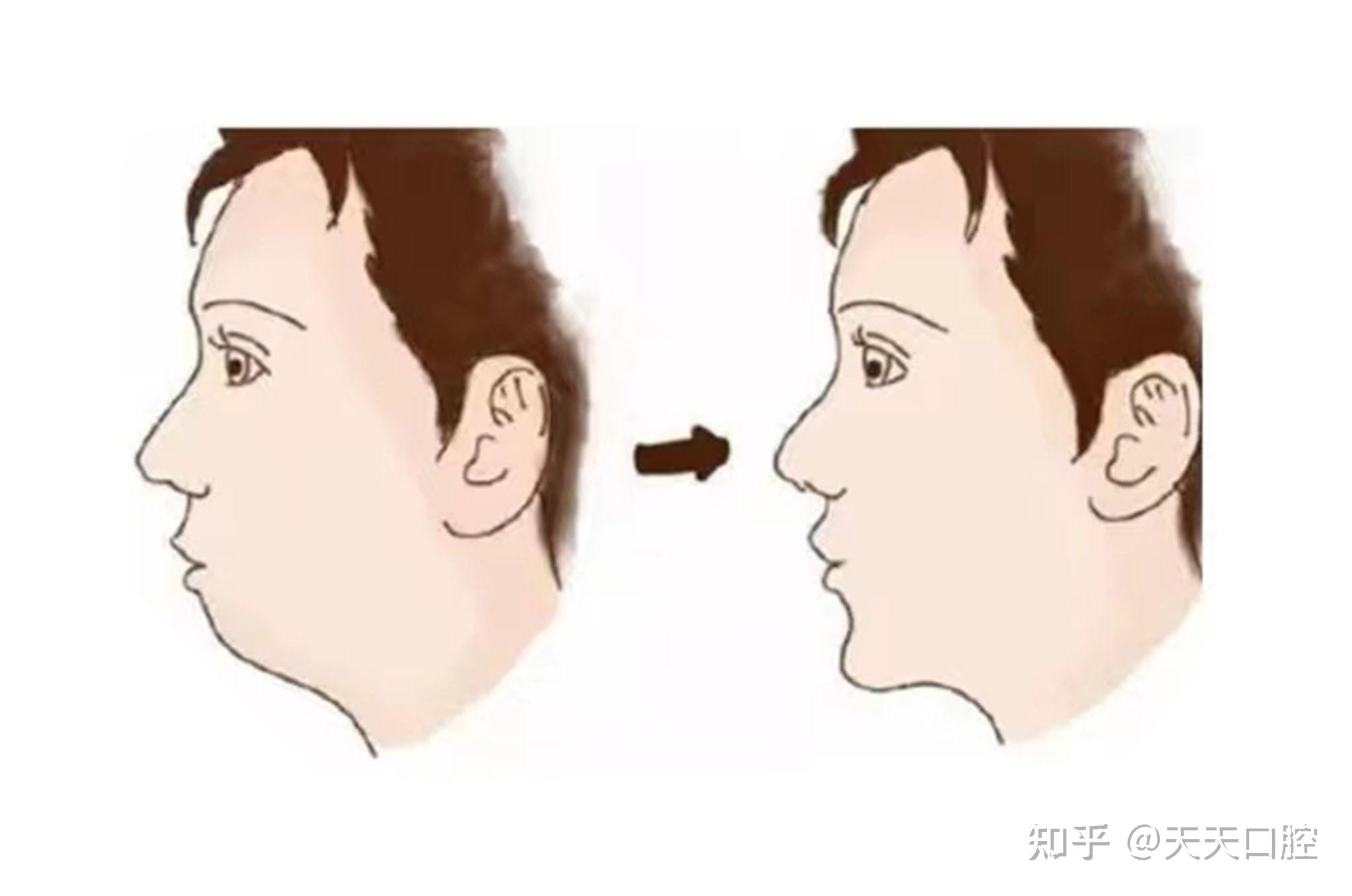 下颌线和下颚线的区别图片